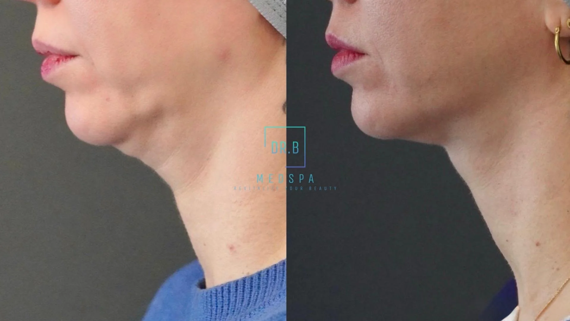 A side-by-side comparison of a woman's chin and jawline before and after a cosmetic procedure, displaying a more defined jawline in the after image.