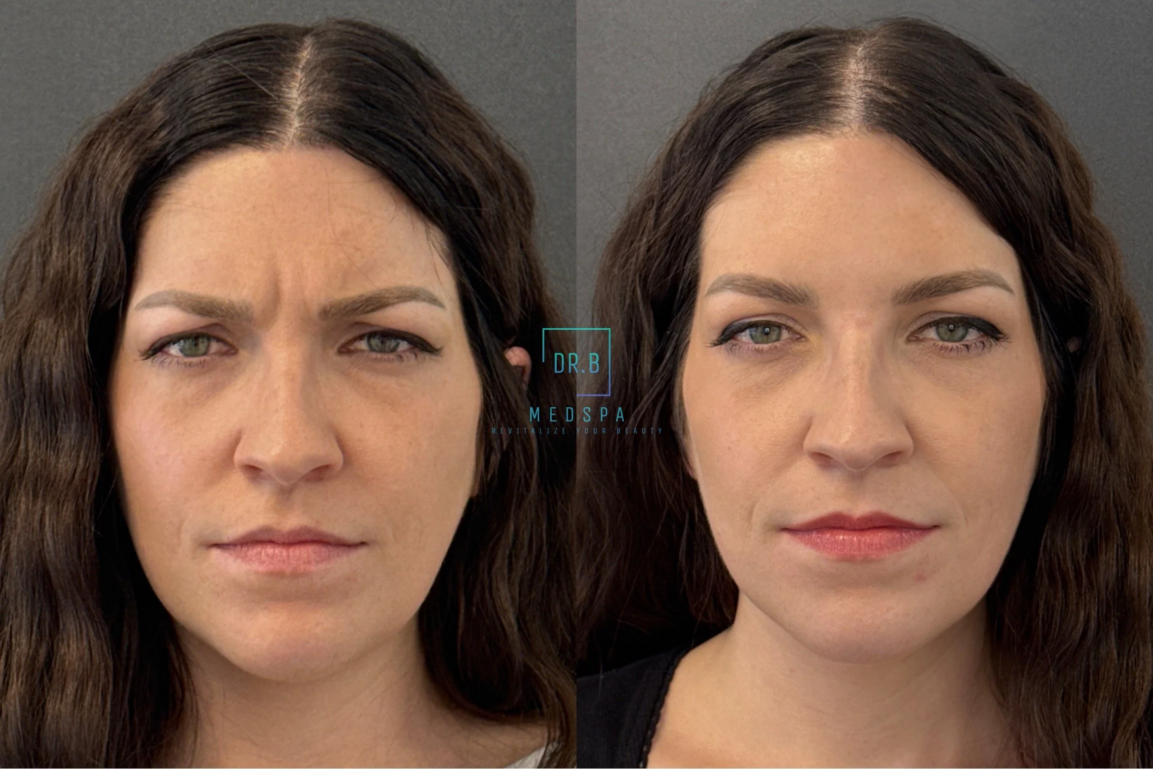 botox5.jpeg