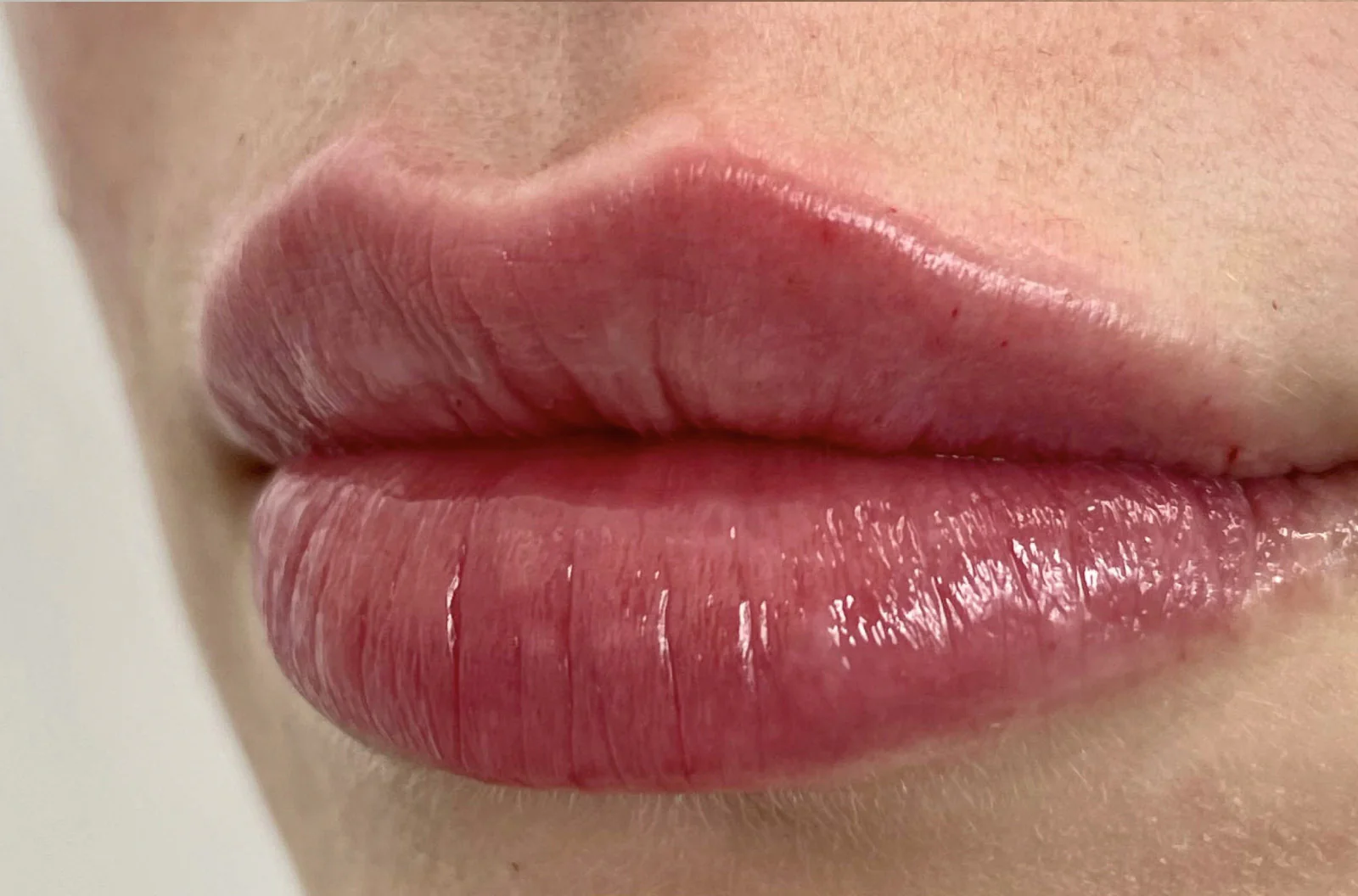 lip flip
