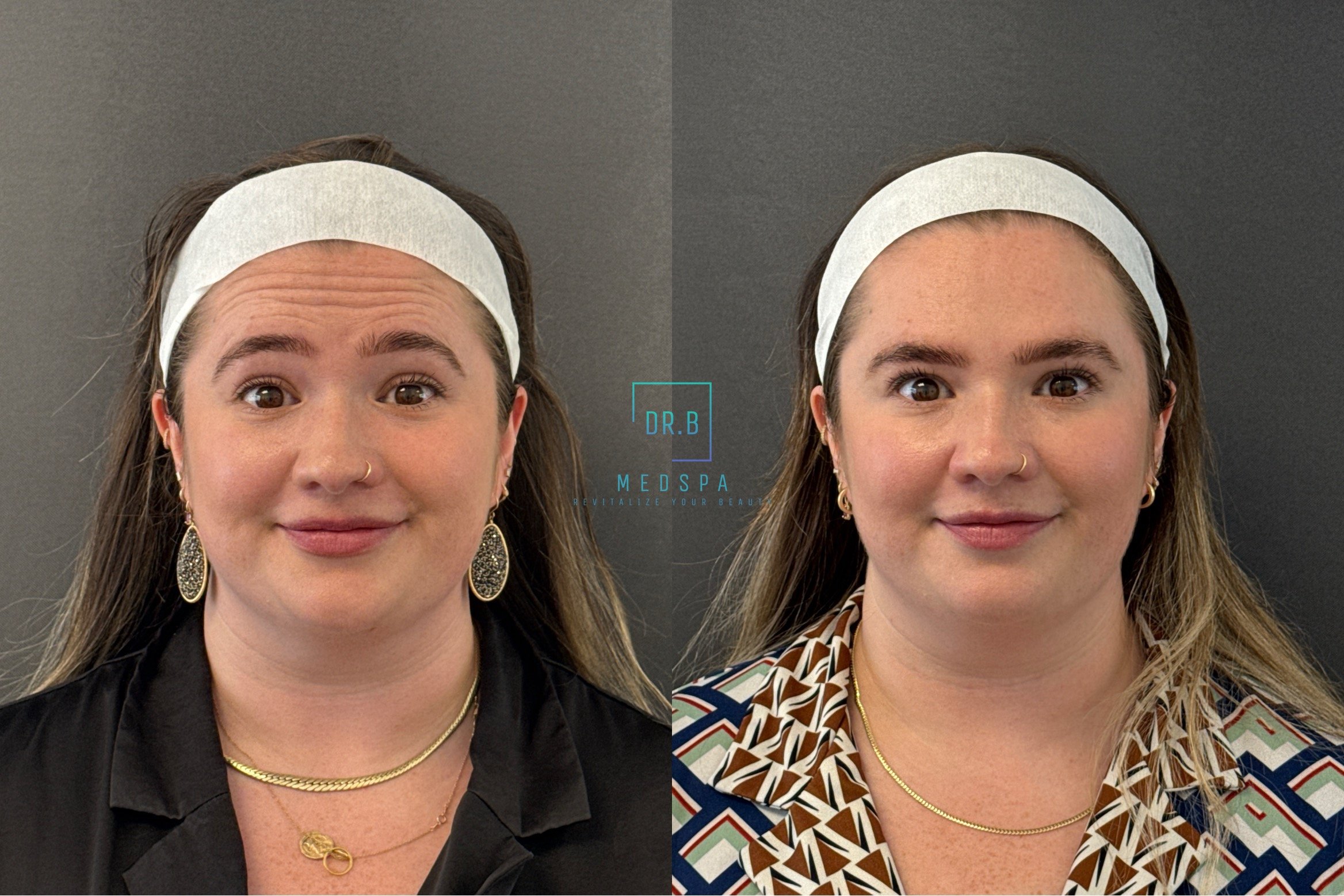 botox 5.jpeg