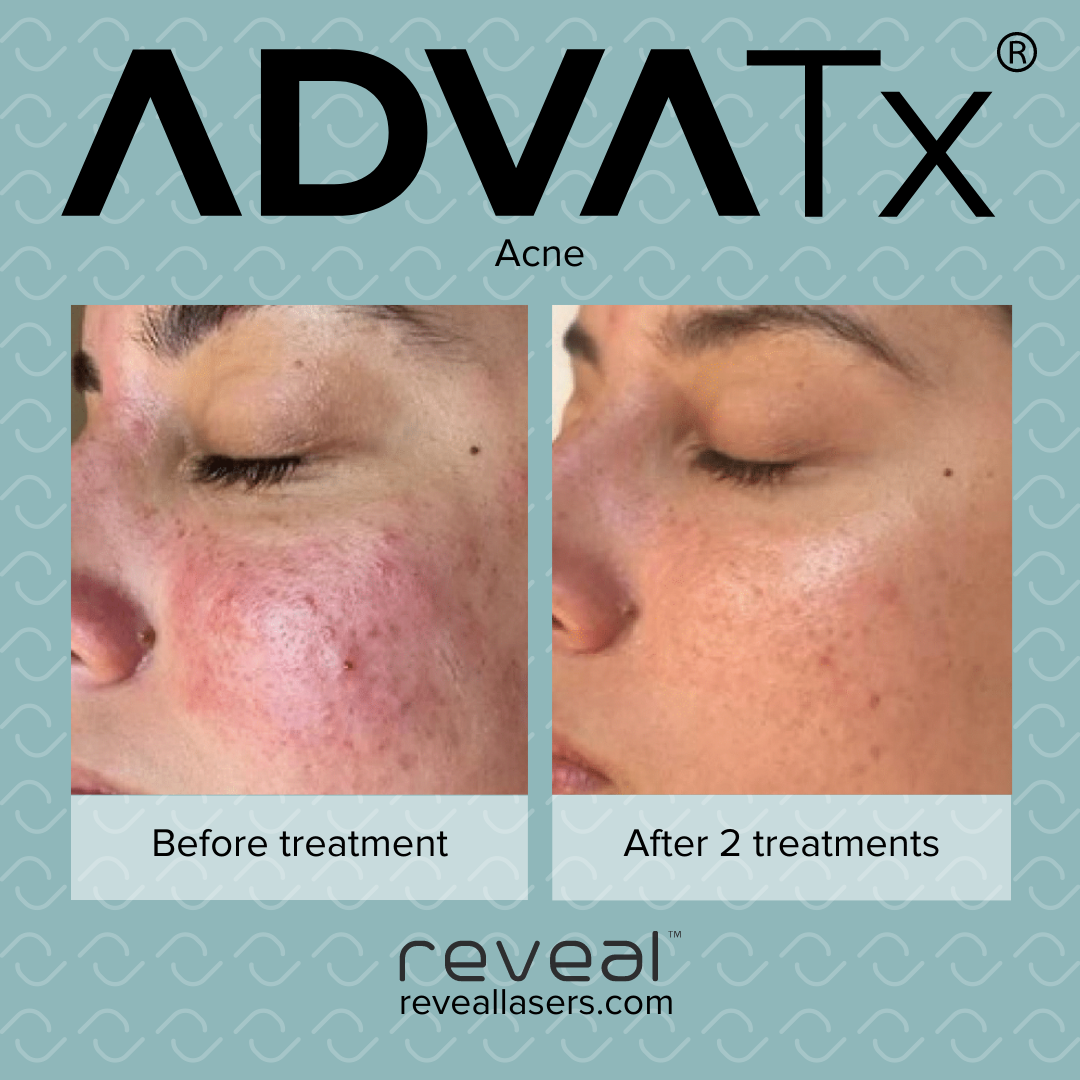 Advertisement showing before and after images of a person's face with acne, highlighting improvements after two treatments, with text 'ADVATx', 'Acne', and the website reveallasers.com.