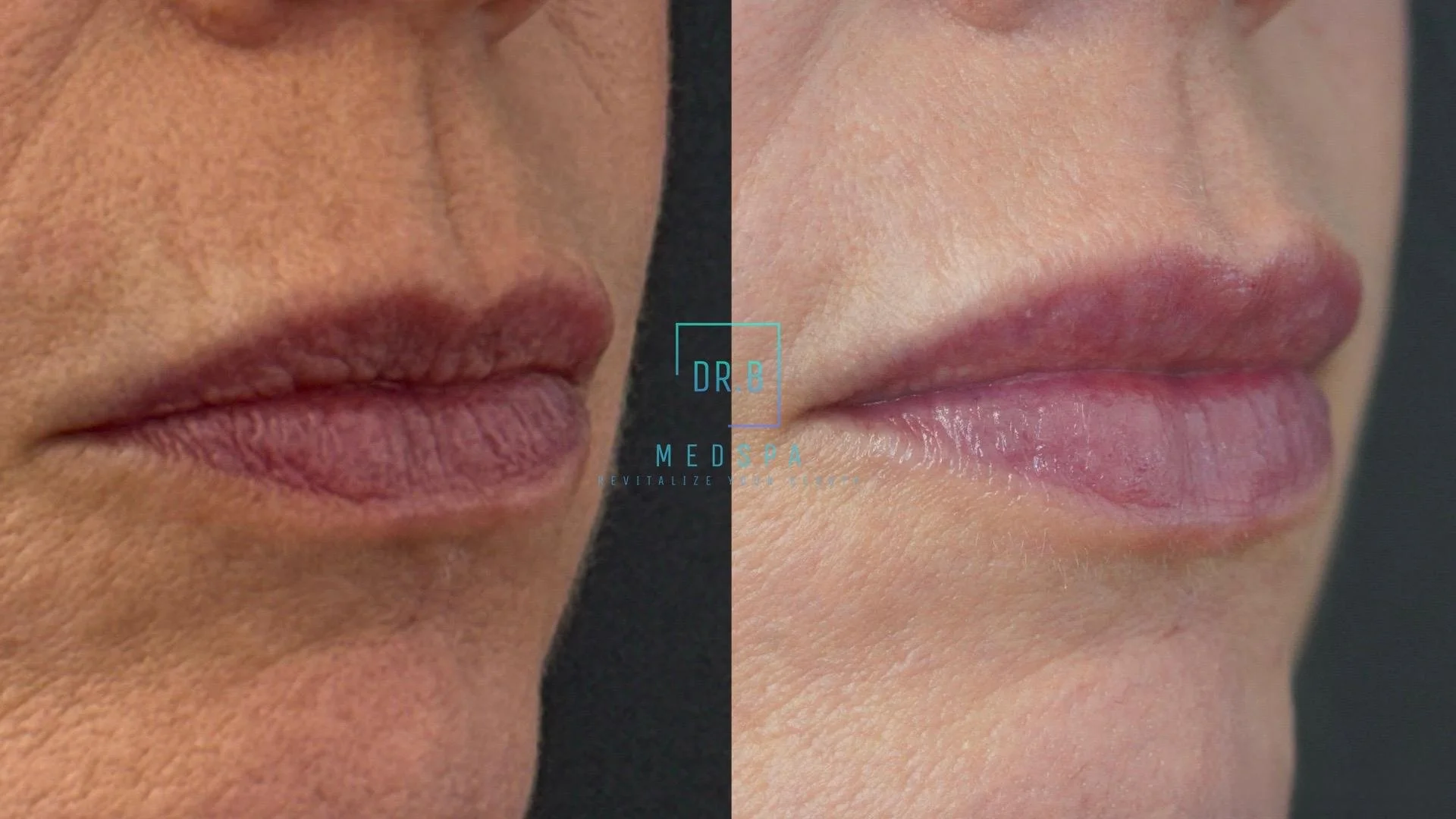 Close-up comparison of lips before and after cosmetic treatment, showing smoother, fuller lips on the right.