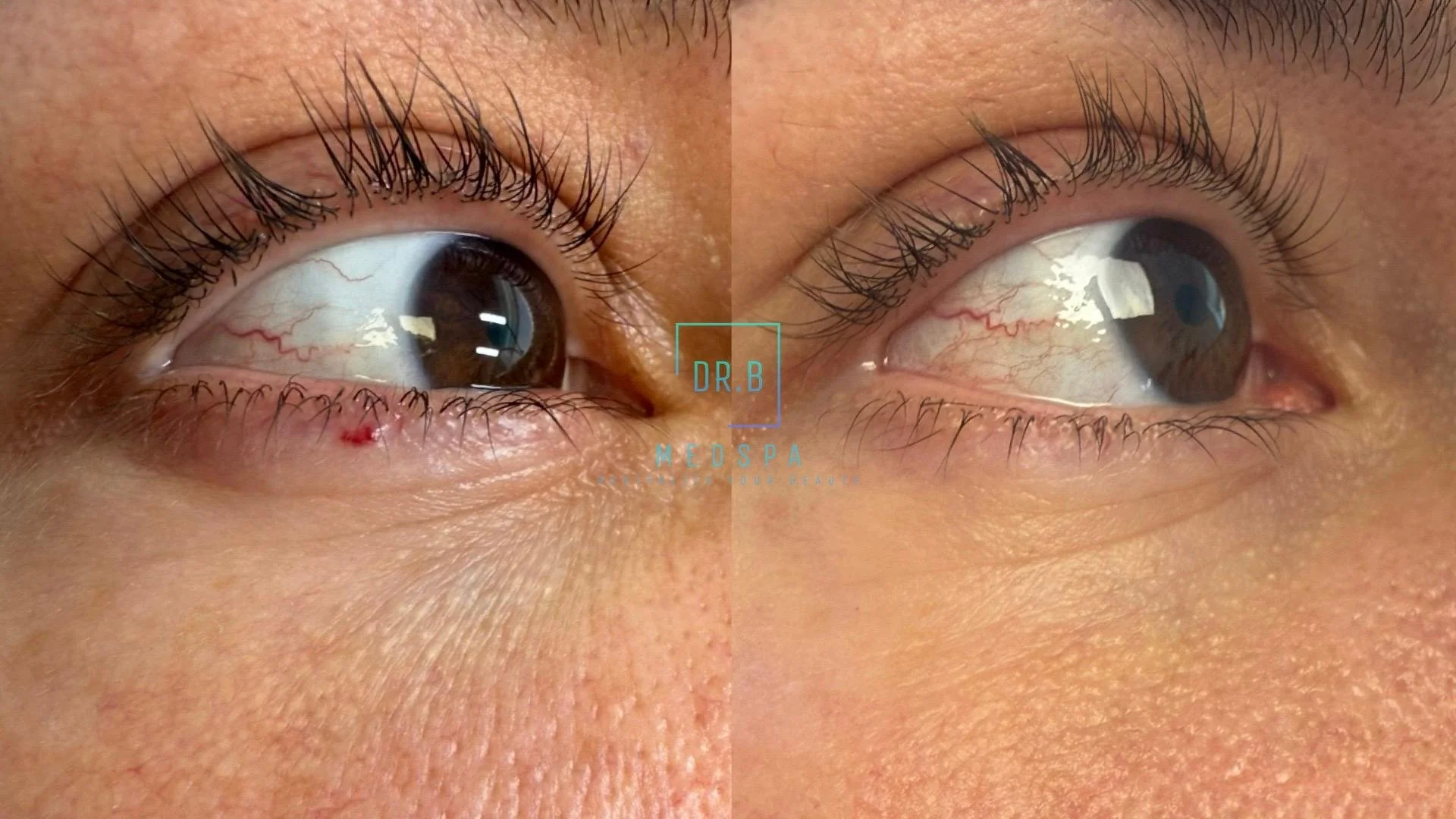 cherry angioma before & after