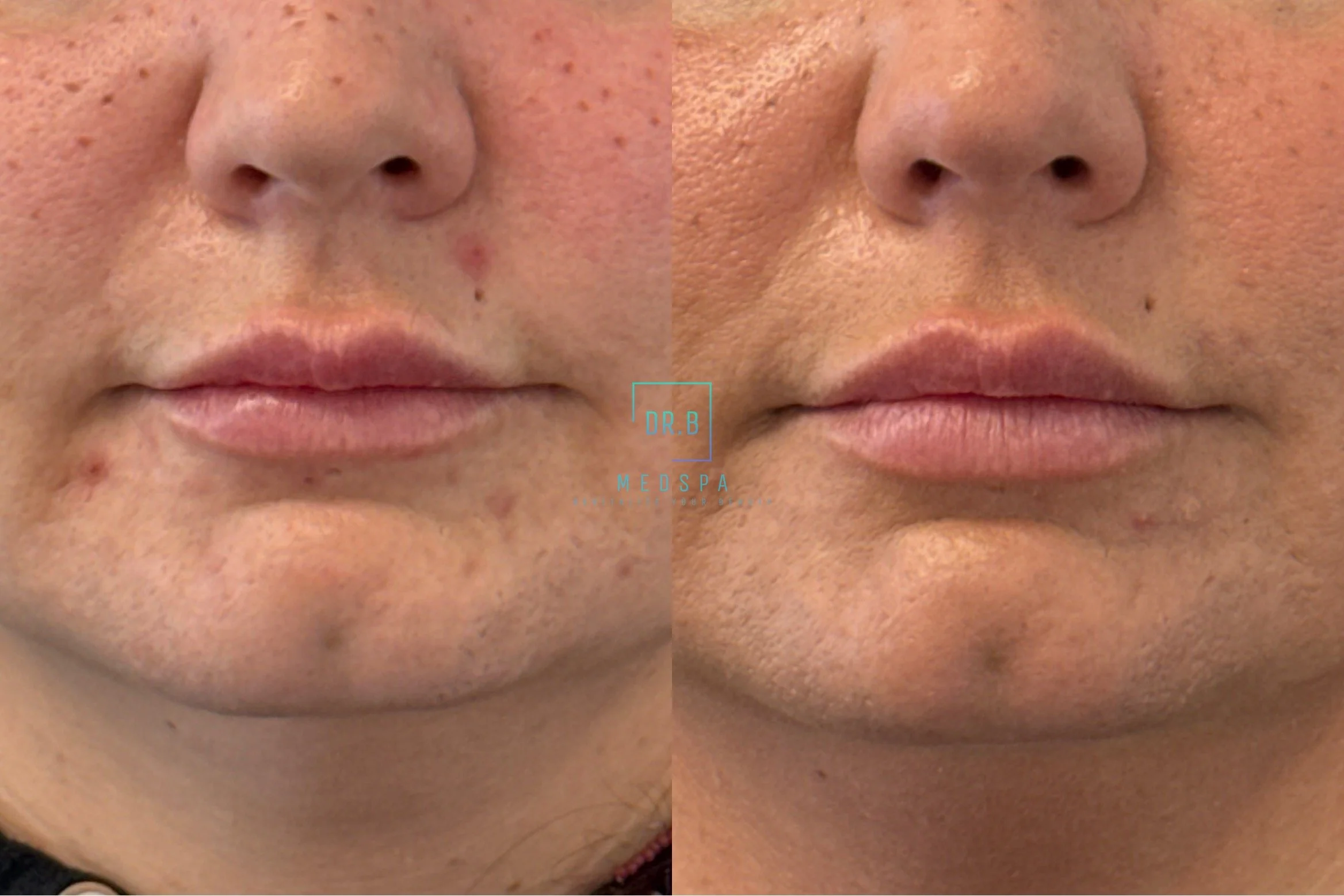 Close-up comparison of skin pores on a person's face, showing before and after skin treatment results with smoother skin.