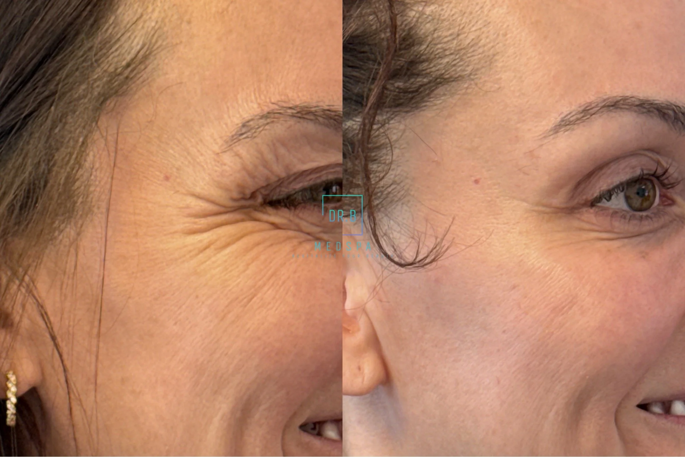 botox 4.jpeg