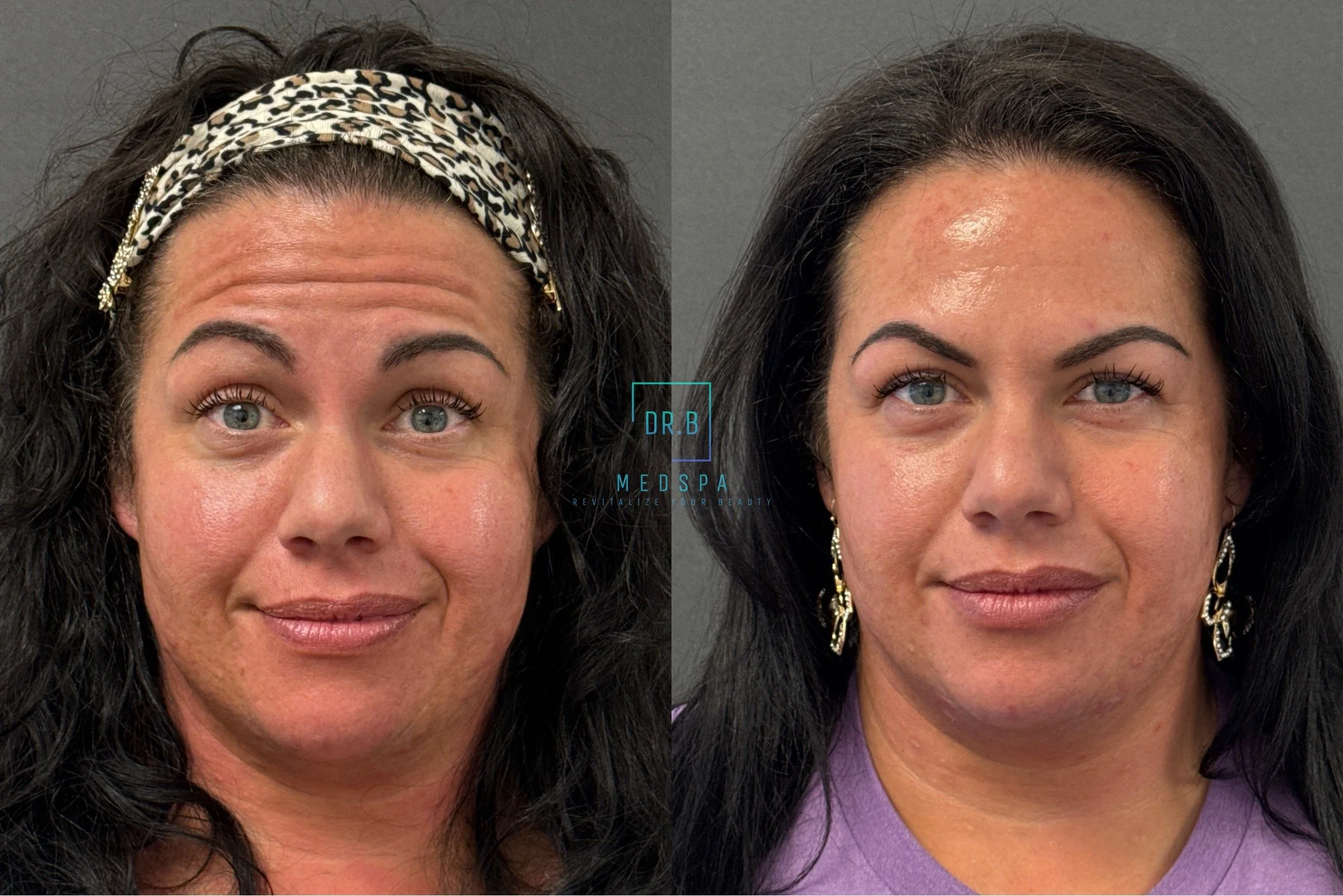 botox treatment in bend before after.jpeg