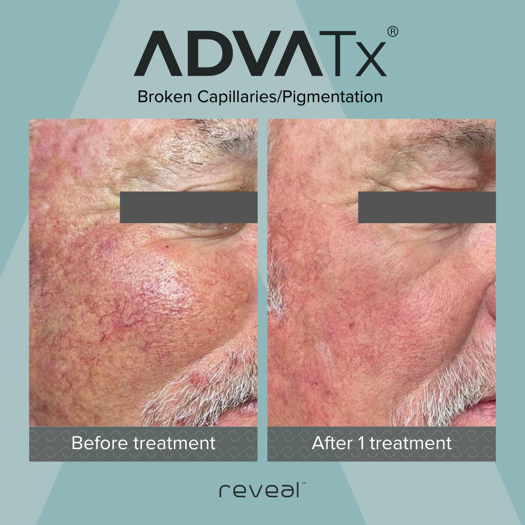 Comparison of facial skin showing broken capillaries and pigmentation before and after one treatment, with 'Before treatment' label on the left and 'After 1 treatment' label on the right.