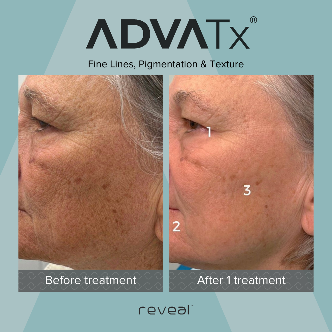 Comparison of skin before and after treatment showing reduced fine lines, pigmentation, and improved texture. The left side shows the 'Before treatment' with more visible signs of aging, while the right side shows 'After 1 treatment' with smoother, c