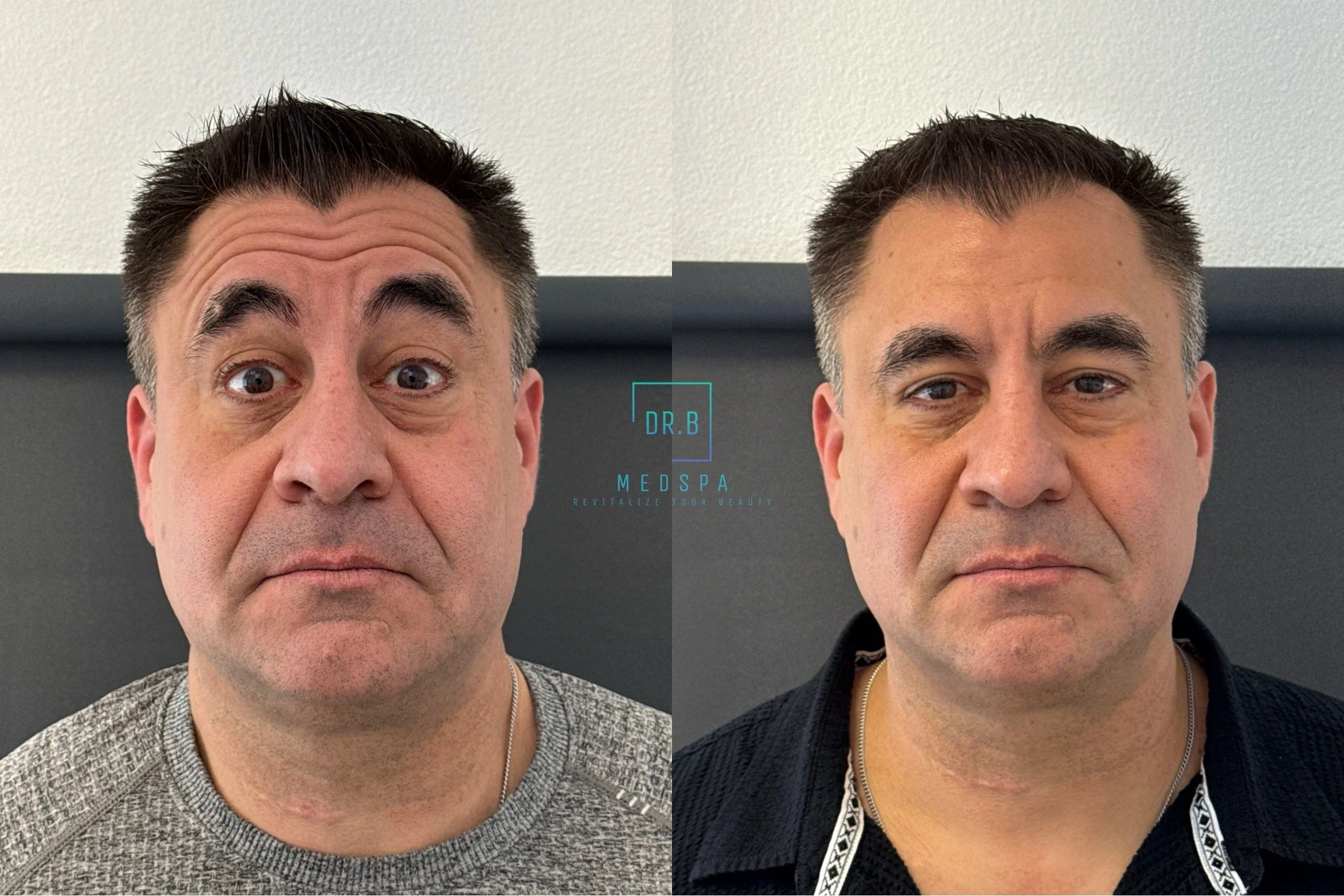 botox wrinkle treatment for men in bend.jpeg