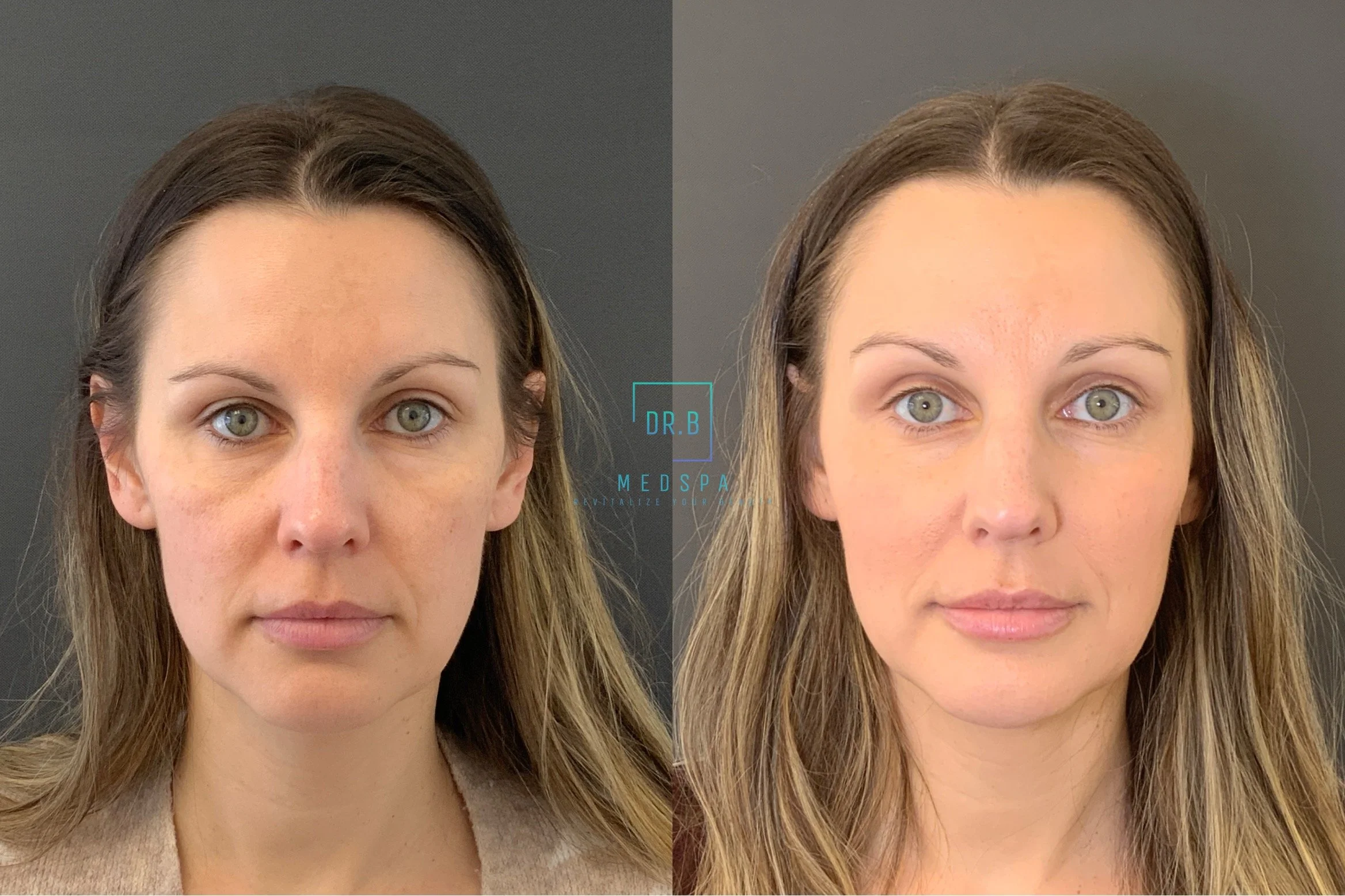 facial balancing.jpeg