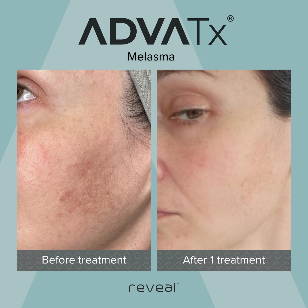 Side-by-side comparison of skin appearance showing an individual’s face before and after melasma treatment, demonstrating improvement in skin pigmentation.