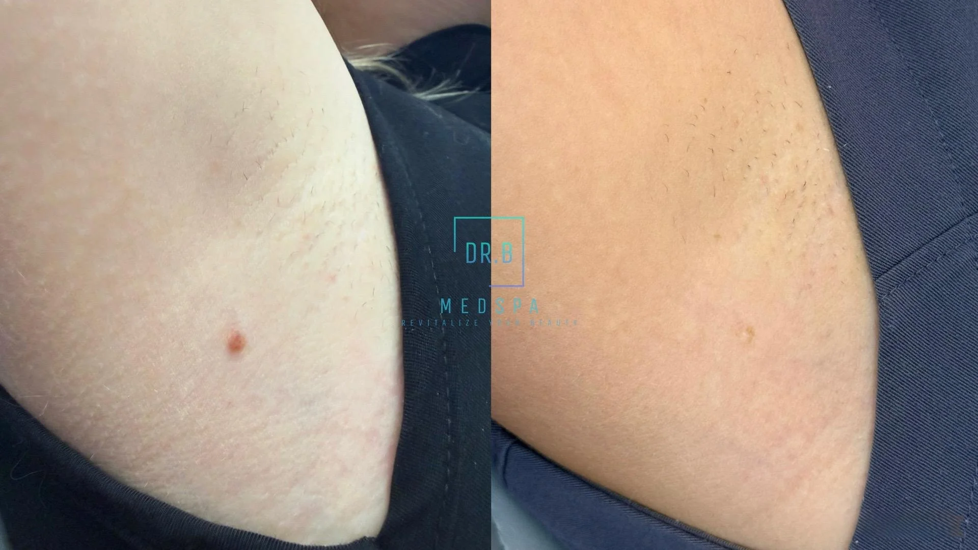 Skin tag & mole removal before after
