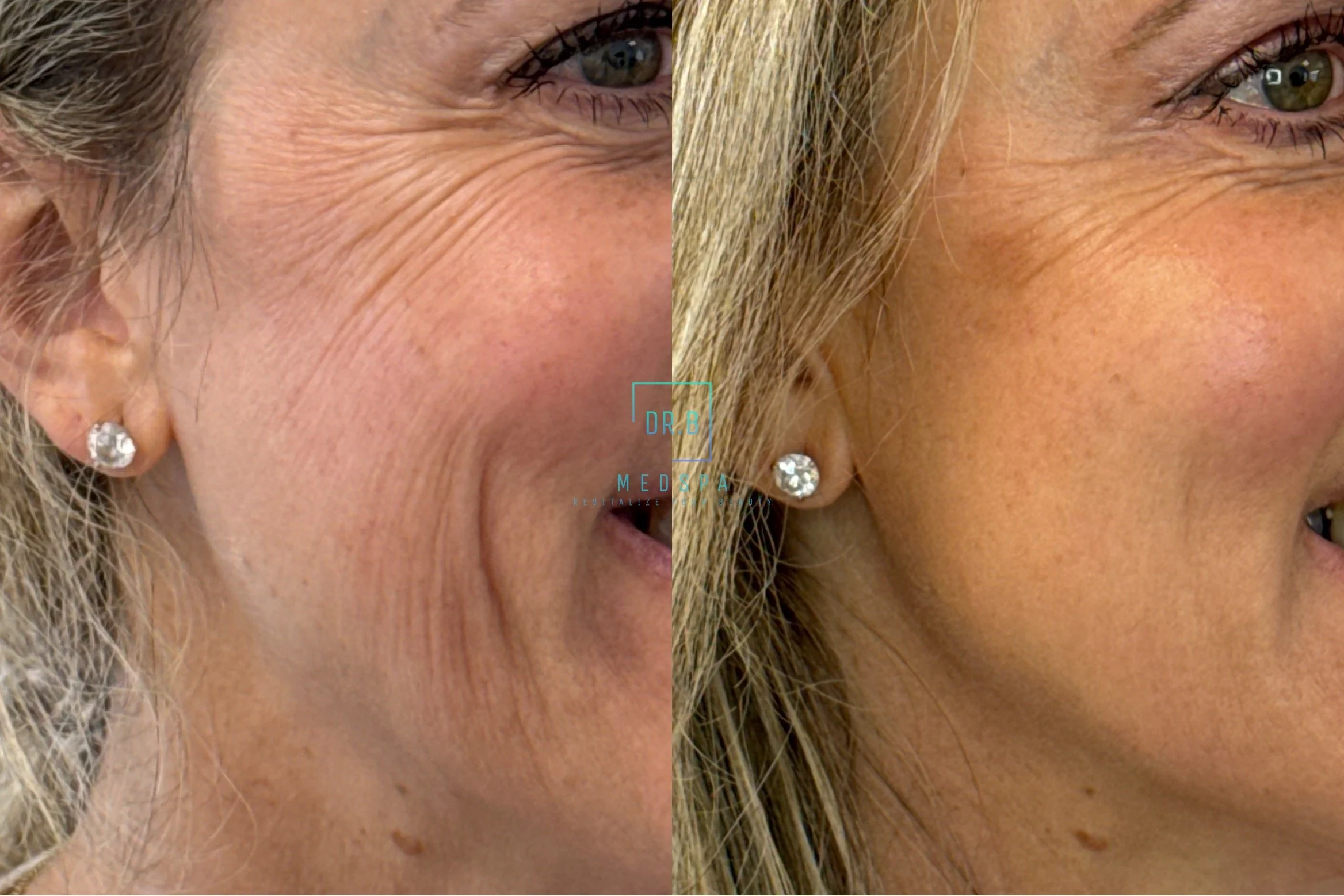 crows feet treatment bend oregon radiesse before after.jpeg