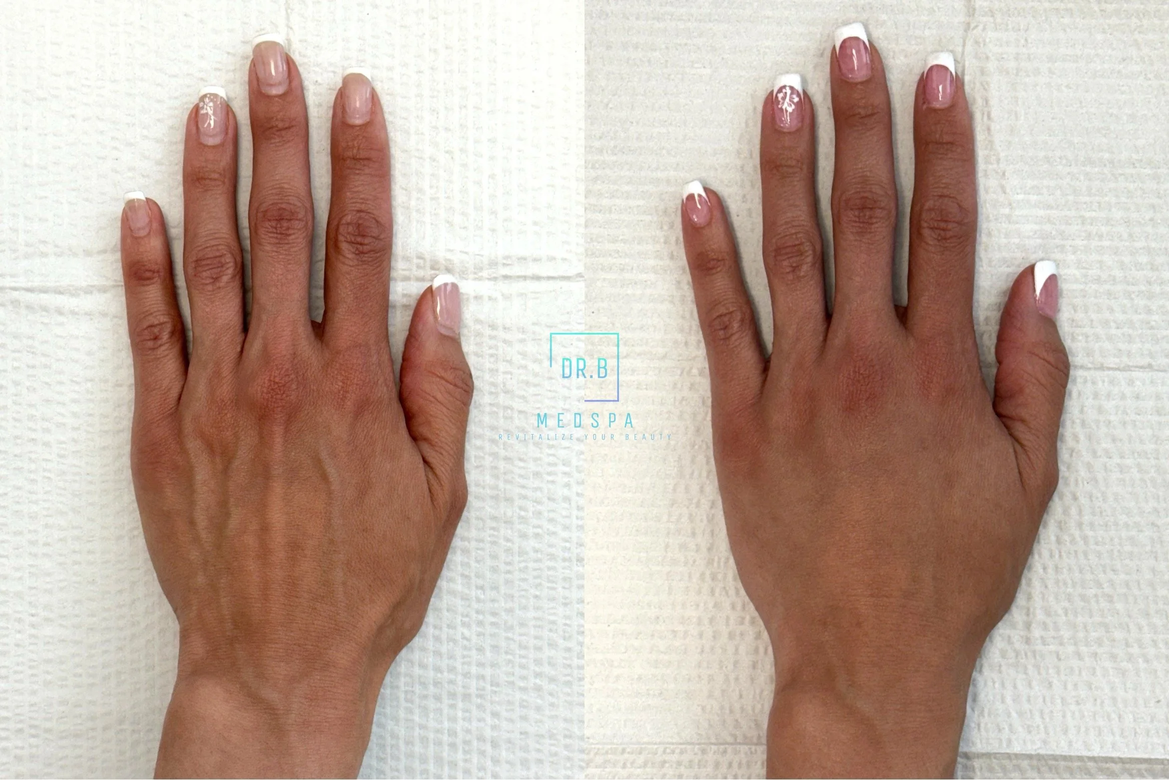 crepey wrinkles on hand treatment before and after.jpeg
