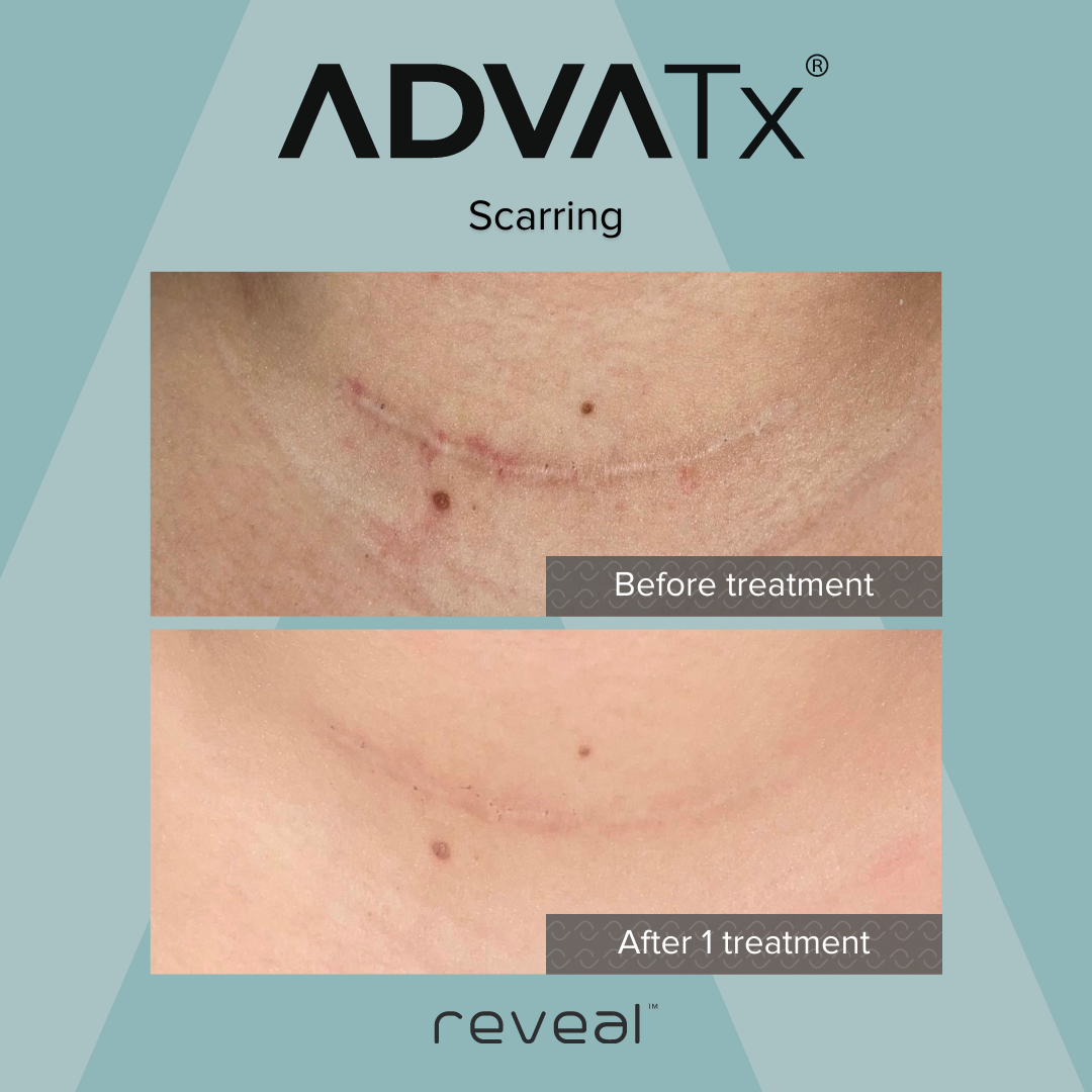 Side-by-side comparison of a scar before and after treatment. The top image shows a red, raised scar with scabbing; the bottom image shows a healed, less noticeable scar. The product branding and labels indicate it is from Advatex, a scar treatment.