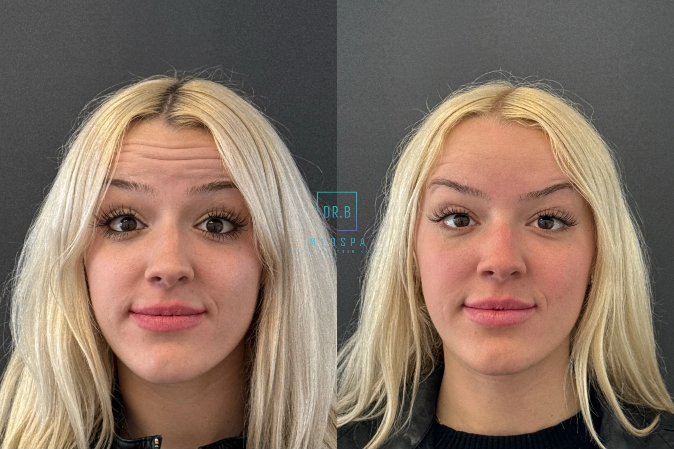 best botox in bend and lip filler before after.jpeg