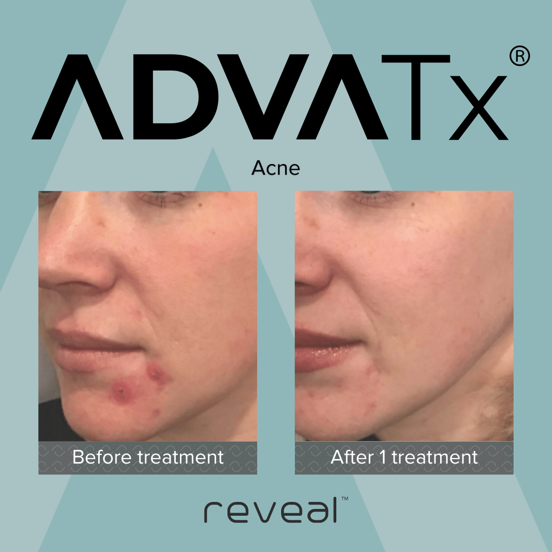 Side-by-side comparison of a woman's face, showing acne before and after one treatment with Reveal skincare product. The 'Before treatment' image shows multiple red pimples on her cheek, while the 'After 1 treatment' image shows clearer skin.