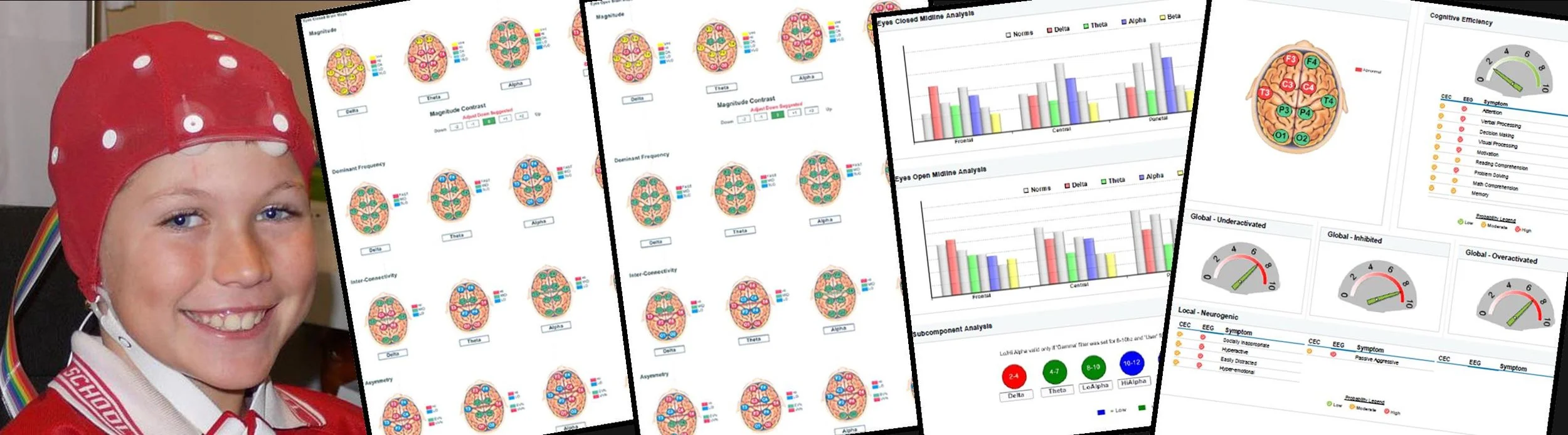 qEEG brain mapping to assess brain function at Jamieson Health Center