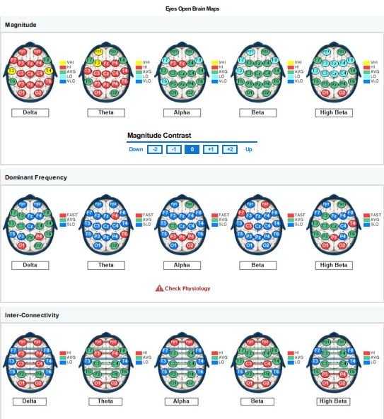 qEEG brain map analysis at Jamieson Health Center