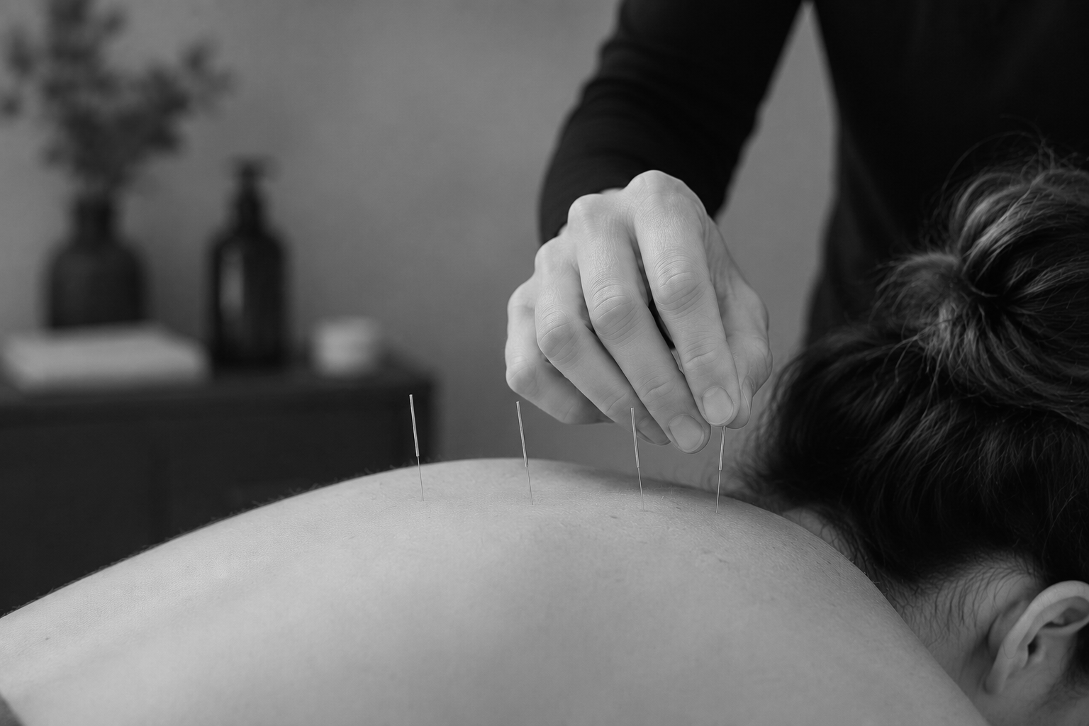 A physiotherapist applying dry needling to an upper back area.