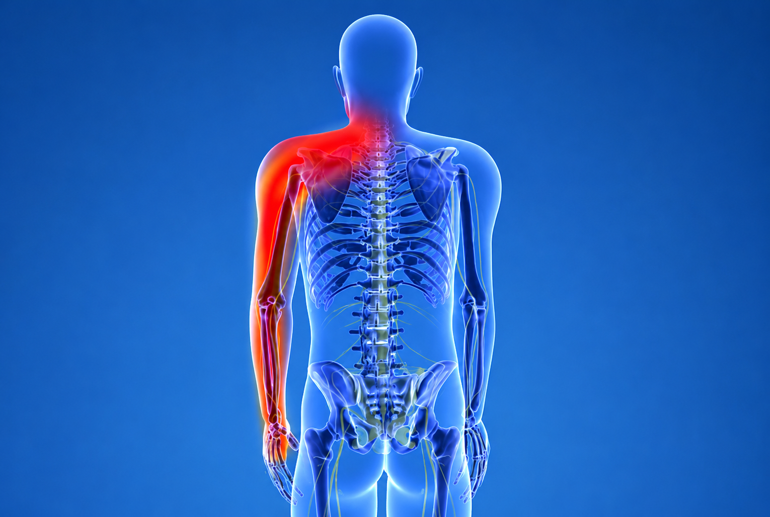 Cervical radiculopathy​