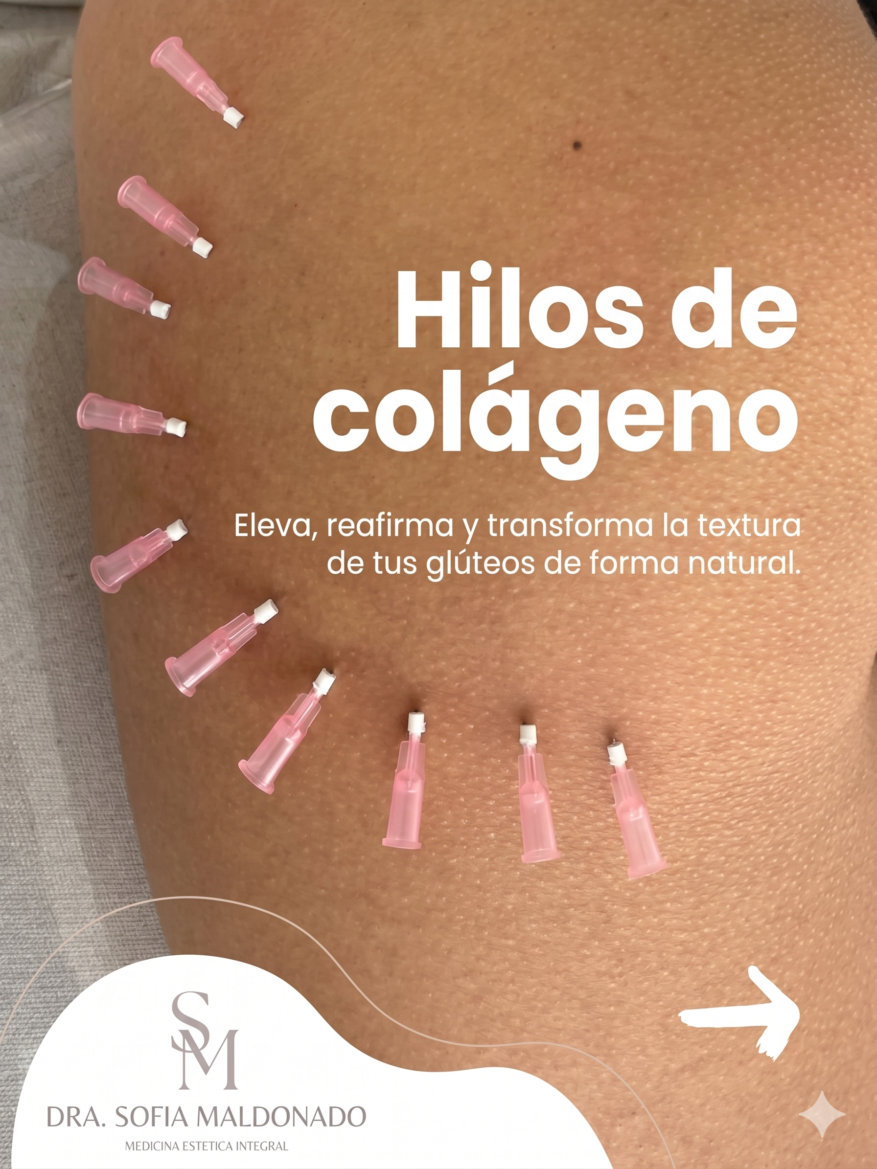 Hilos de Colágeno | Dra. Sofia Maldonado - Medicina Estética