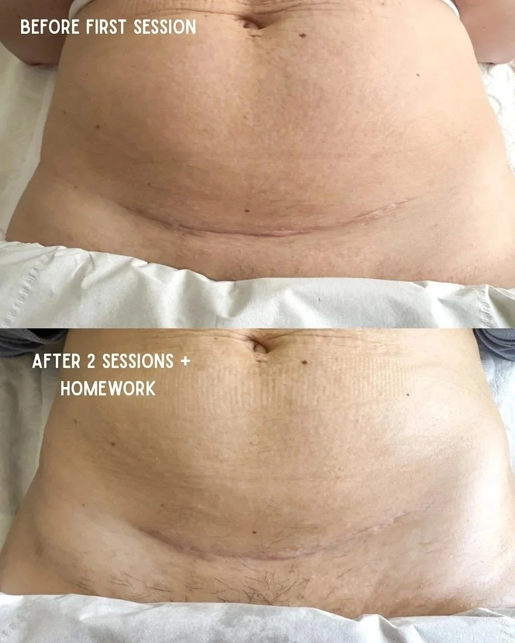 Comparison of a person's abdominal area before and after 2 sessions and homework, showing reduced skin laxity and improved skin tone.
