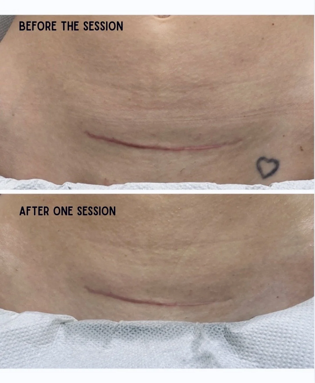 Close-up of a person's lower face showing a healing scar before and after one session of treatment, with a small heart tattoo visible on the skin.