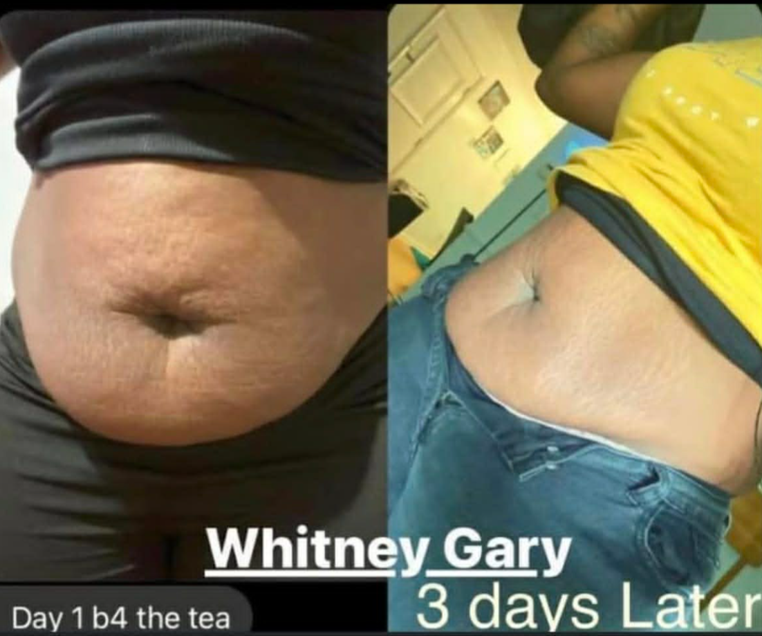 Comparison of a person's abdominal area before and after a few days, showing skin texture and belly button. The left side shows a slightly textured skin and the right side shows similar skin with slight change. Text on the image reads: 'Whitney Gary,