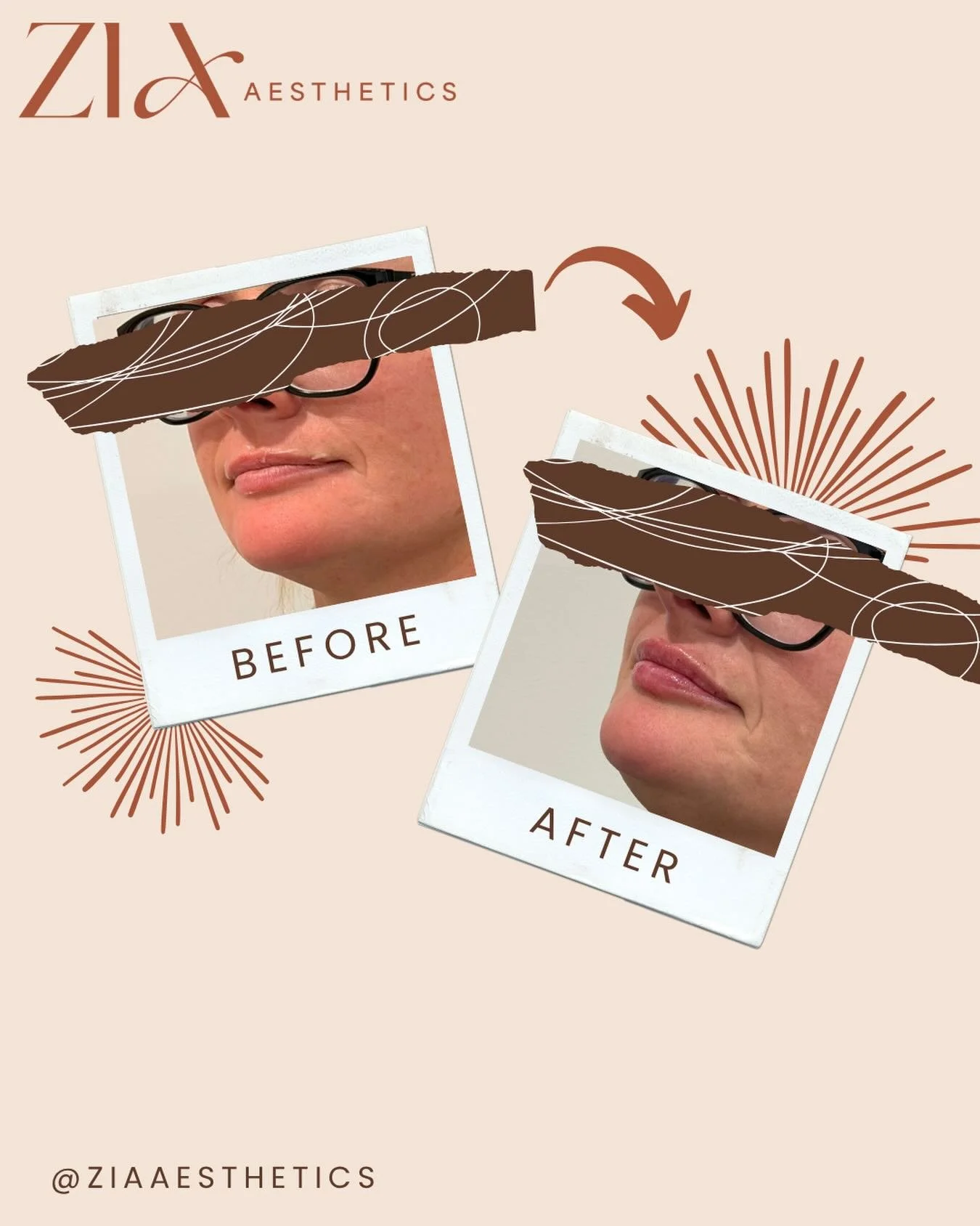 What a transformation with just 0.6ml! 👄✨

Natural, subtle, and beautifully balanced.

This gorgeous enhancement has given her top lip a little more support, so it won&rsquo;t disappear every time she smiles. Plus&hellip; there&rsquo;s finally some 