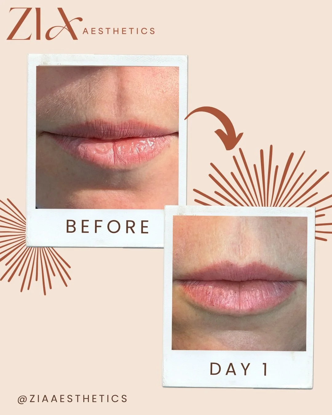 Bacio Lips &mdash; Day One 💋

**Treatment 1 of 3**

Day one of my Bacio Lips journey! ✨

Bacio Lips is a lip booster treatment focused on hydration, not volume. It can help improve the overall hydration and appearance of the lips and may also enhanc