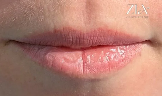 Day Zero
I have always suffered from dry flaking lips. No matter how much water I drink, lip balm I use I just always have dry lips so when I found this treatment for lip hydration I knew I had to try it and have it on offer for others! 
Skinfill Bac