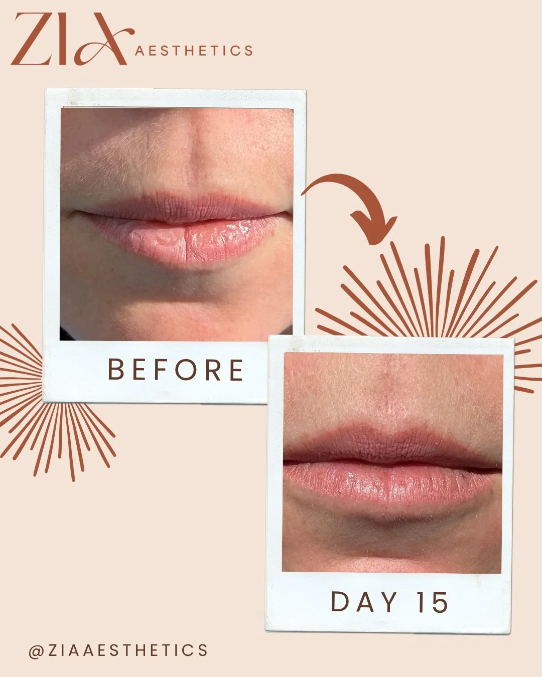@derma.lis Skinfill Bacio Lip Booster ✨

Wowow&hellip; what results!

I genuinely couldn&rsquo;t recommend this treatment more for anyone struggling with dry, dehydrated or constantly chapped lips.

I&rsquo;ve suffered with the most chapped lips for 