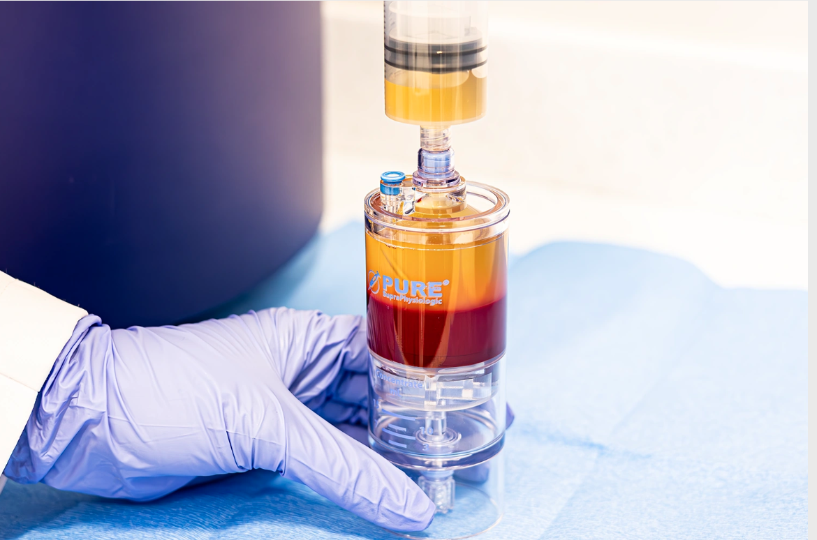 A gloved hand holding a medical device filled with layered orange, yellow, and red liquids, used for blood separation in a laboratory setting.
