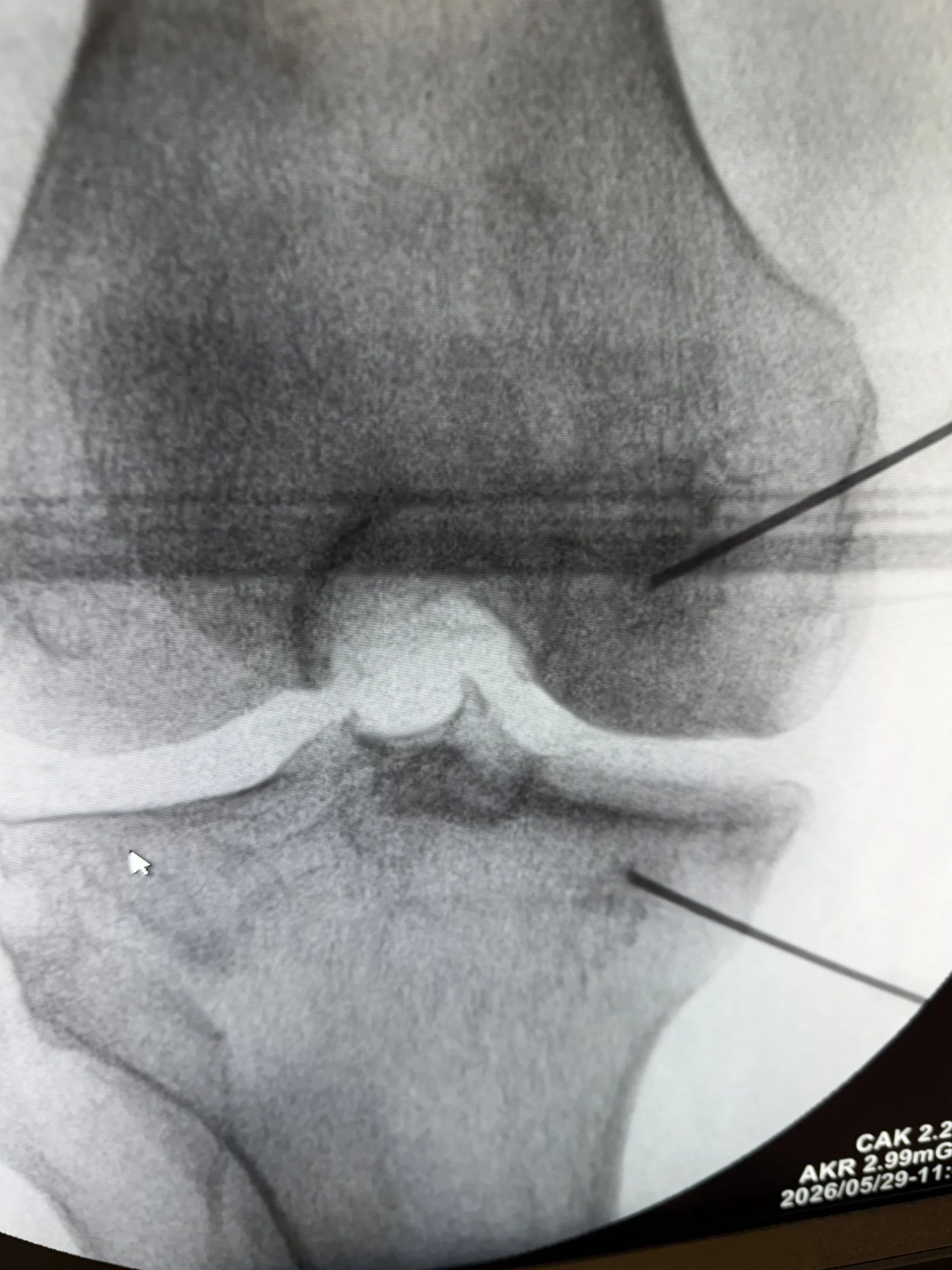 Precision image-guided intraosseous bone marrow concentrate injection performed for knee osteoarthritis treatment.