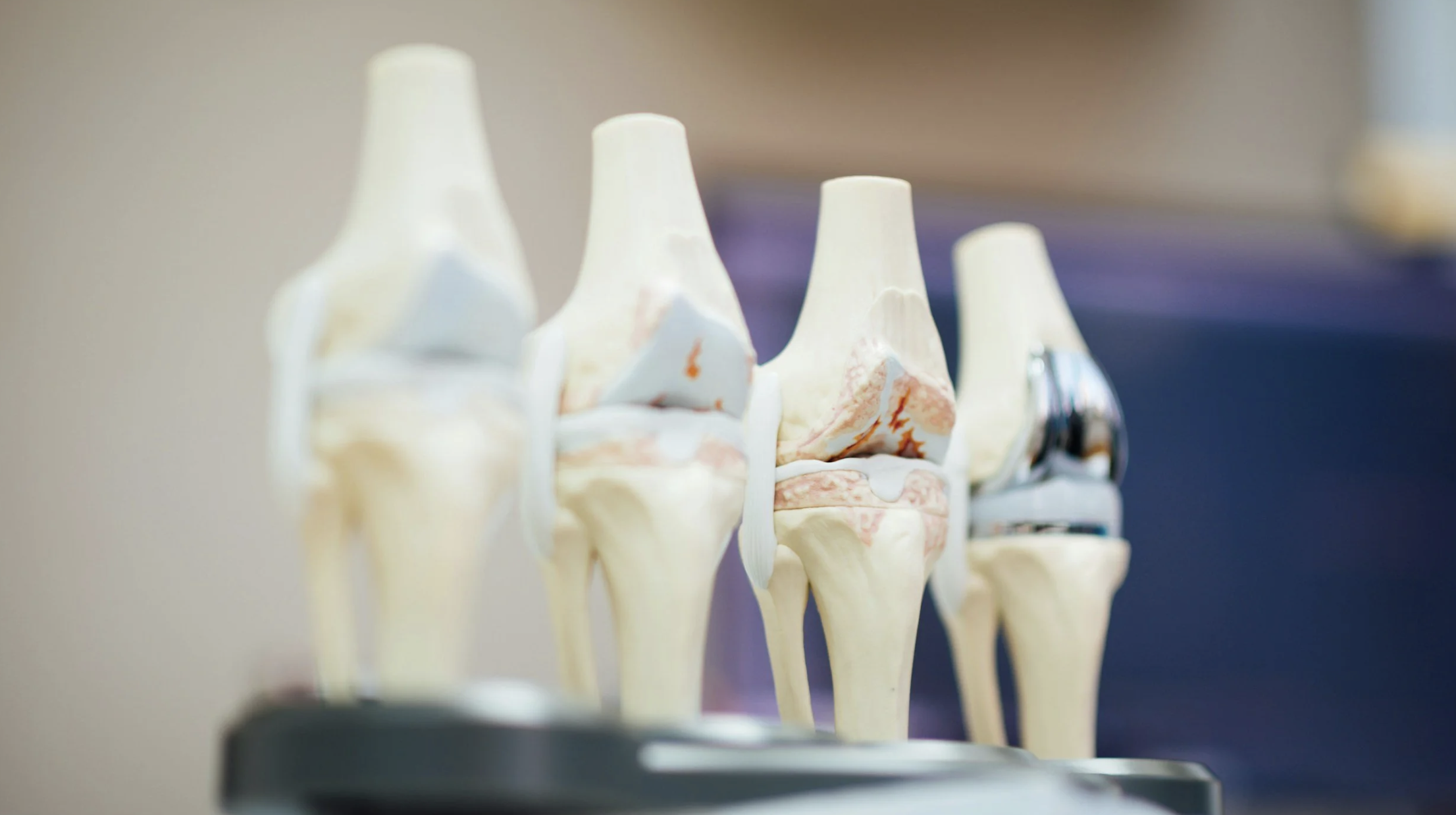 Osteoarthritis