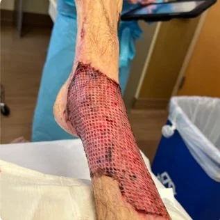Advanced wound care treatment in westchester ny by wound care expert john marzano