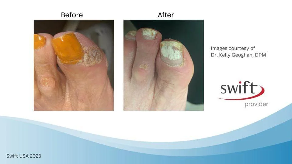 SWIFT® Microwave Therapy For Plantar Warts