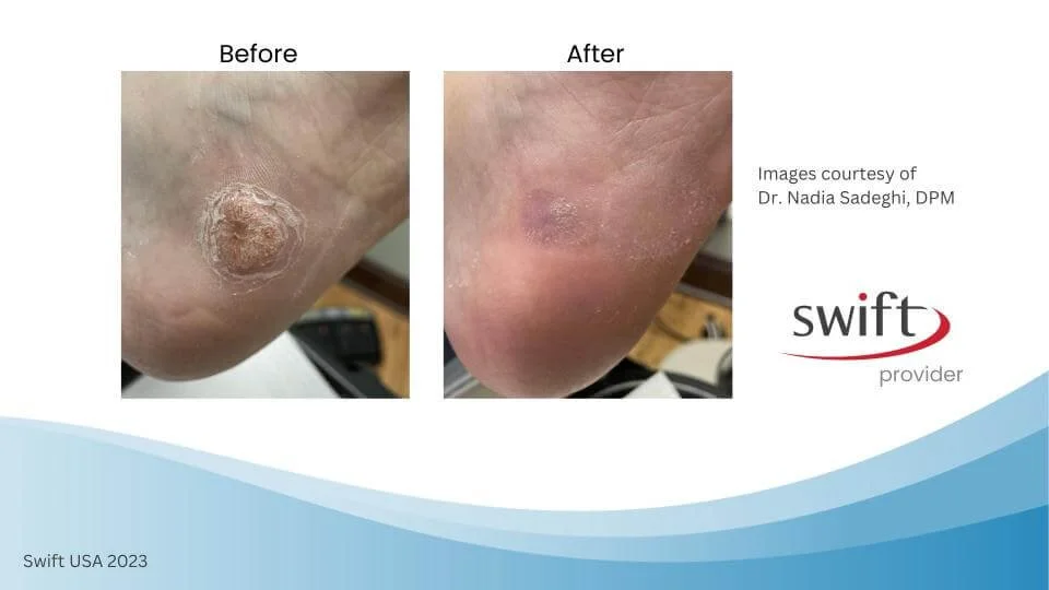 SWIFT® Microwave Therapy For Plantar Warts