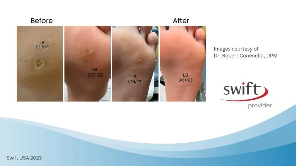 SWIFT® Microwave Therapy For Plantar Warts