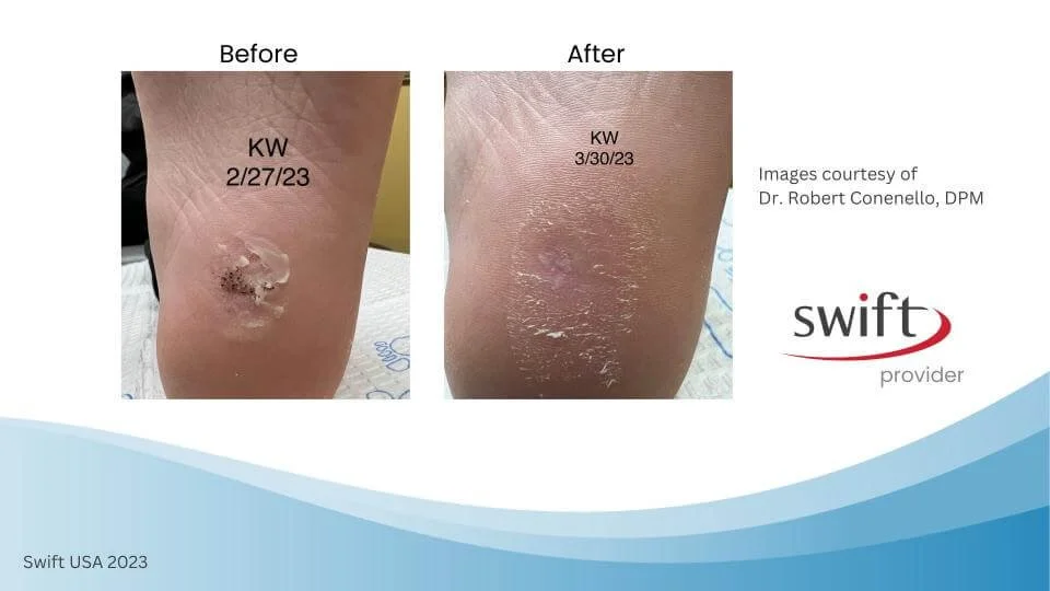 SWIFT® Microwave Therapy For Plantar Warts