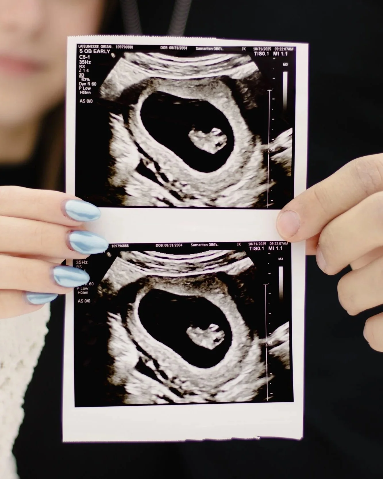 Two ultrasound printouts being held by a person with light blue painted nails. The ultrasound images show an early stage pregnancy with a developing fetus.