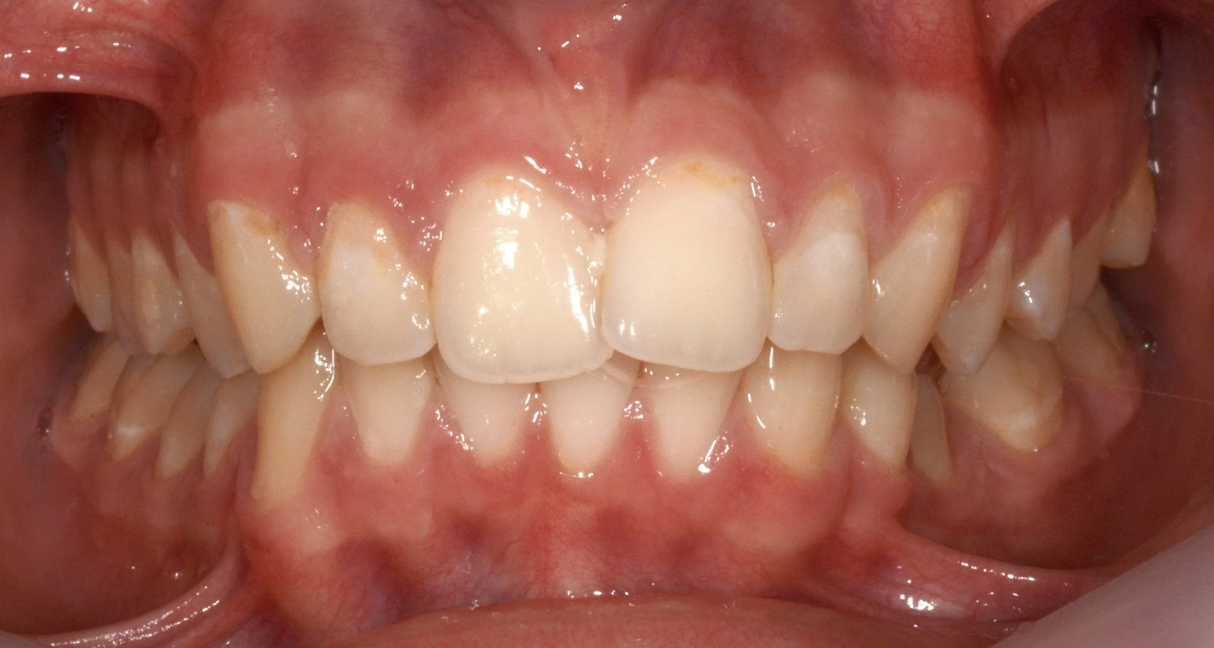 Close-up of a person's upper and lower teeth, showing some misalignment and yellowish staining on some teeth.