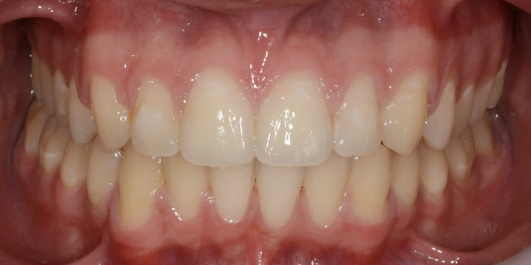 Close-up of a person's upper and lower teeth with pink gums.