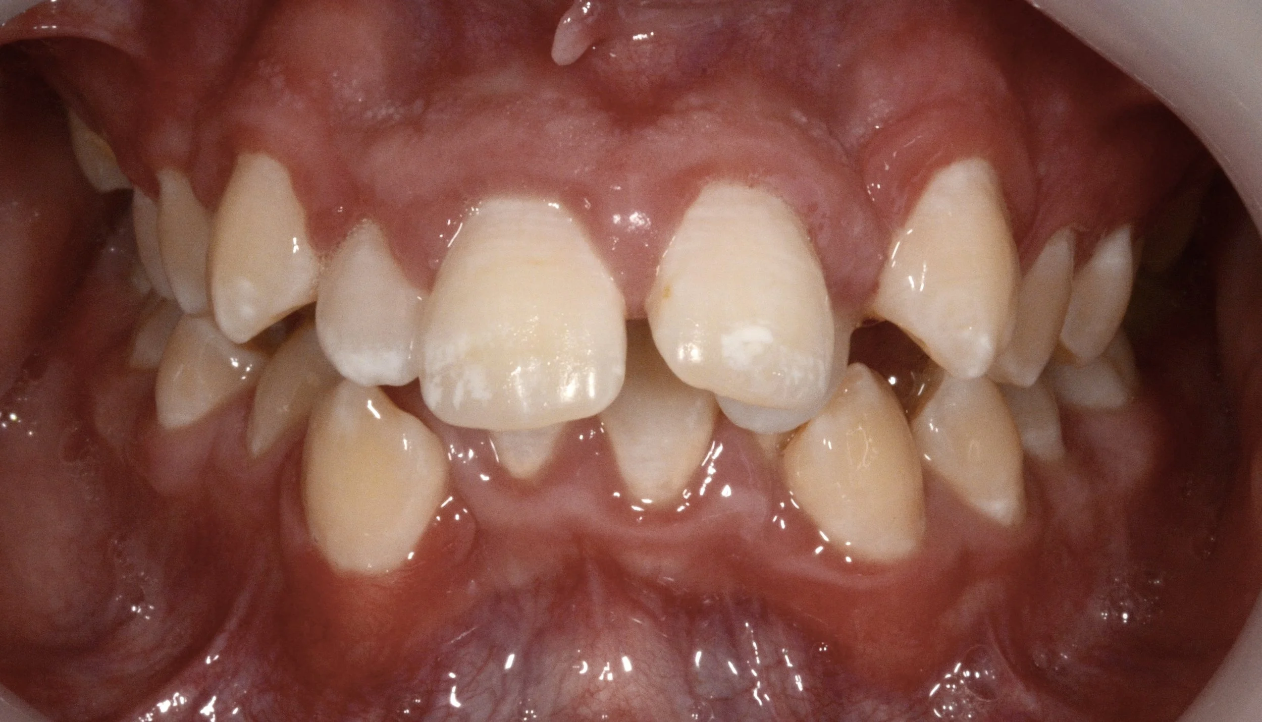 Close-up of a person's upper teeth and gums with several missing teeth and visible plaque or discoloration.