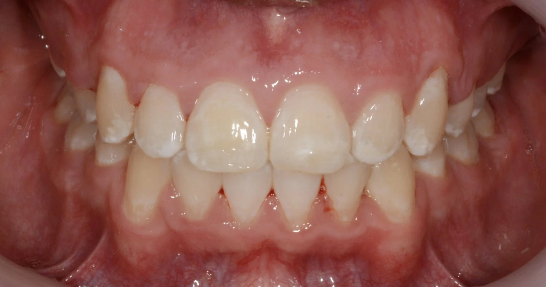 Close-up of teeth with noticeable misalignment and crowding in the upper and lower jaw.