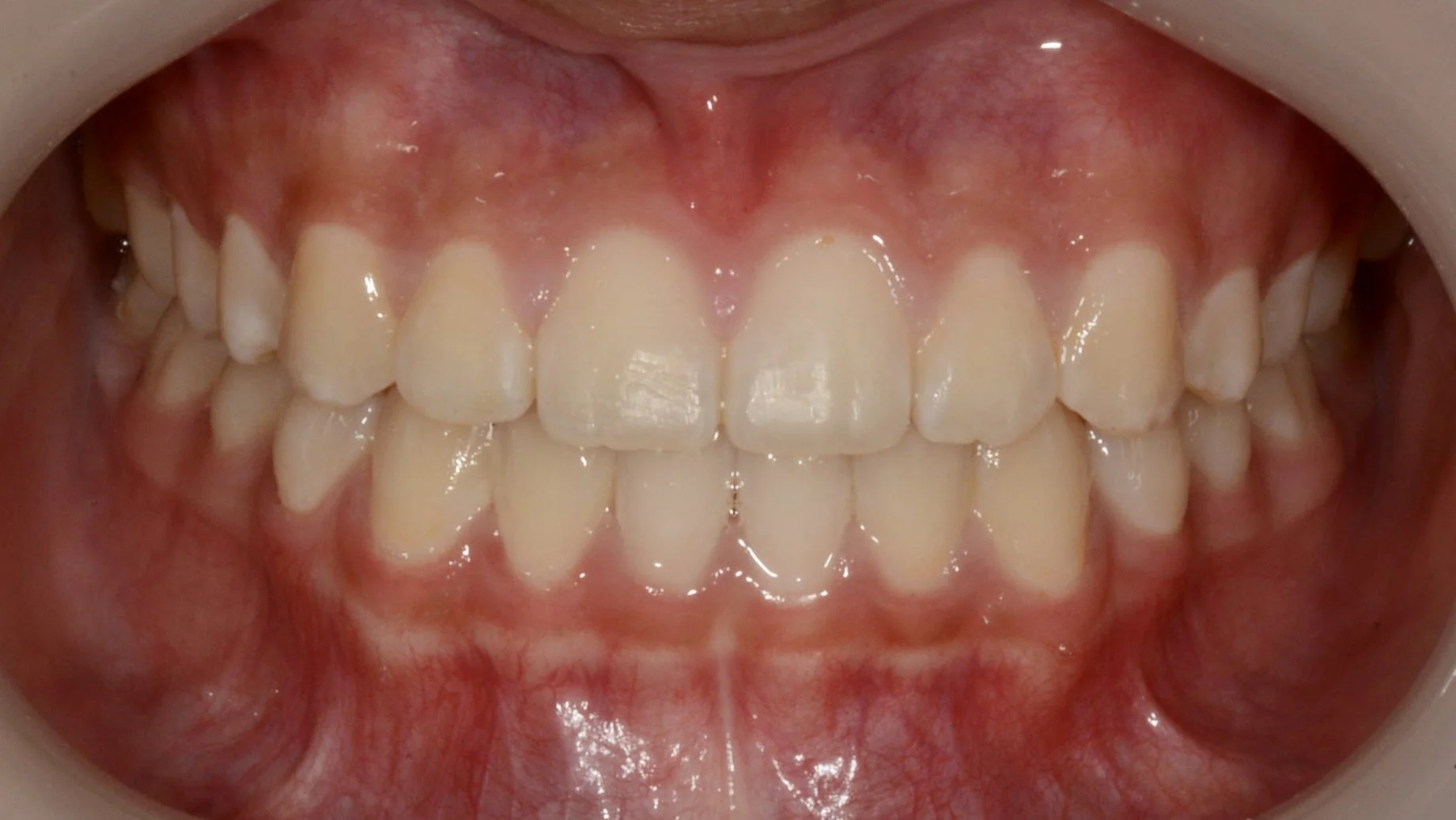 Close-up of a person's set of upper and lower teeth with pink gums, showing healthy teeth with slight misalignment.