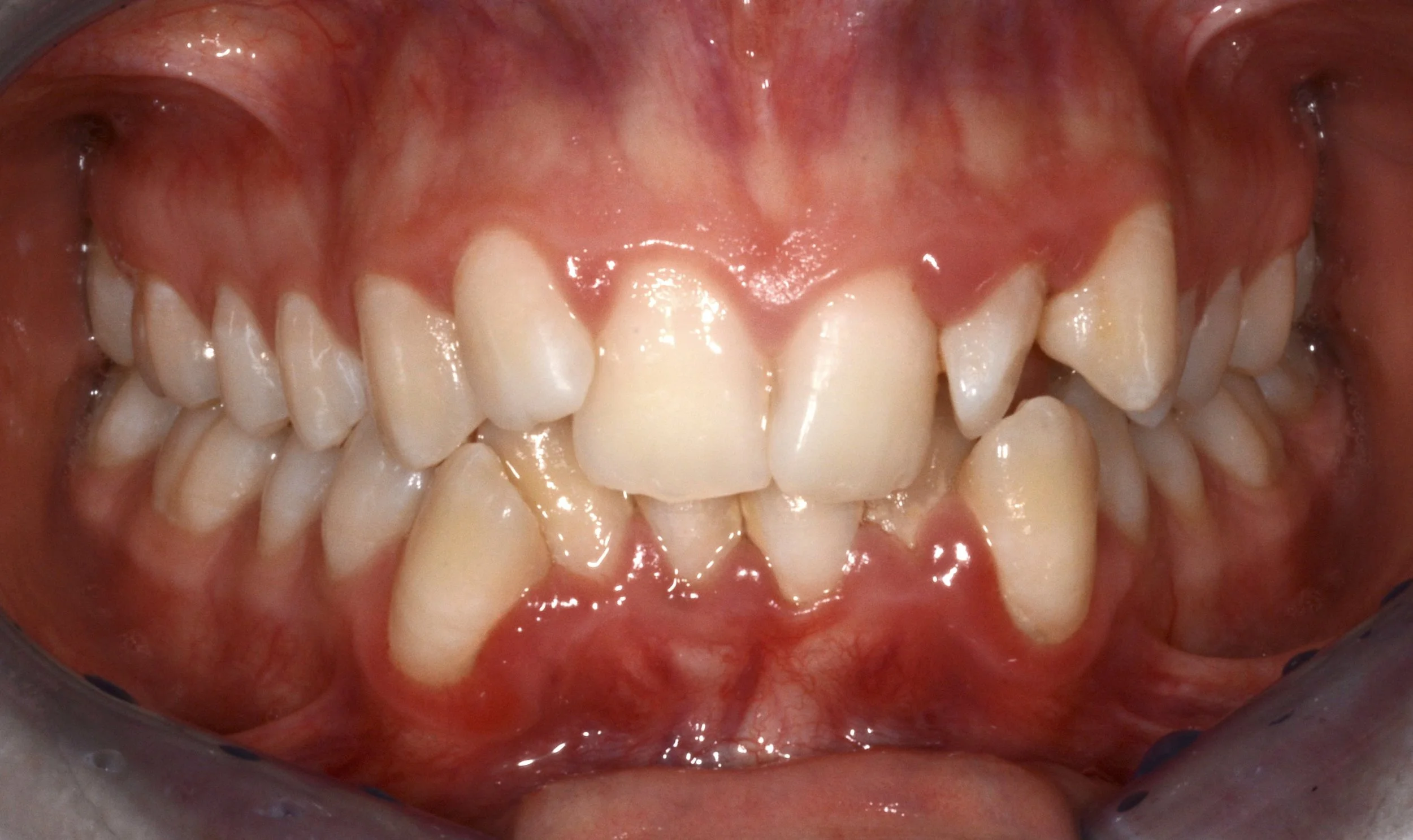 Close-up view of upper teeth and gums with signs of inflammation and redness.