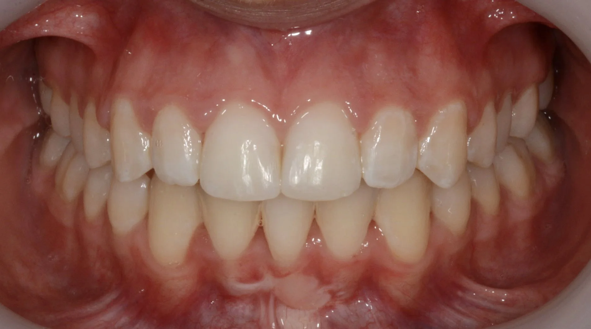 Close-up of a person's open mouth showing upper and lower teeth, with some gum inflammation visible.