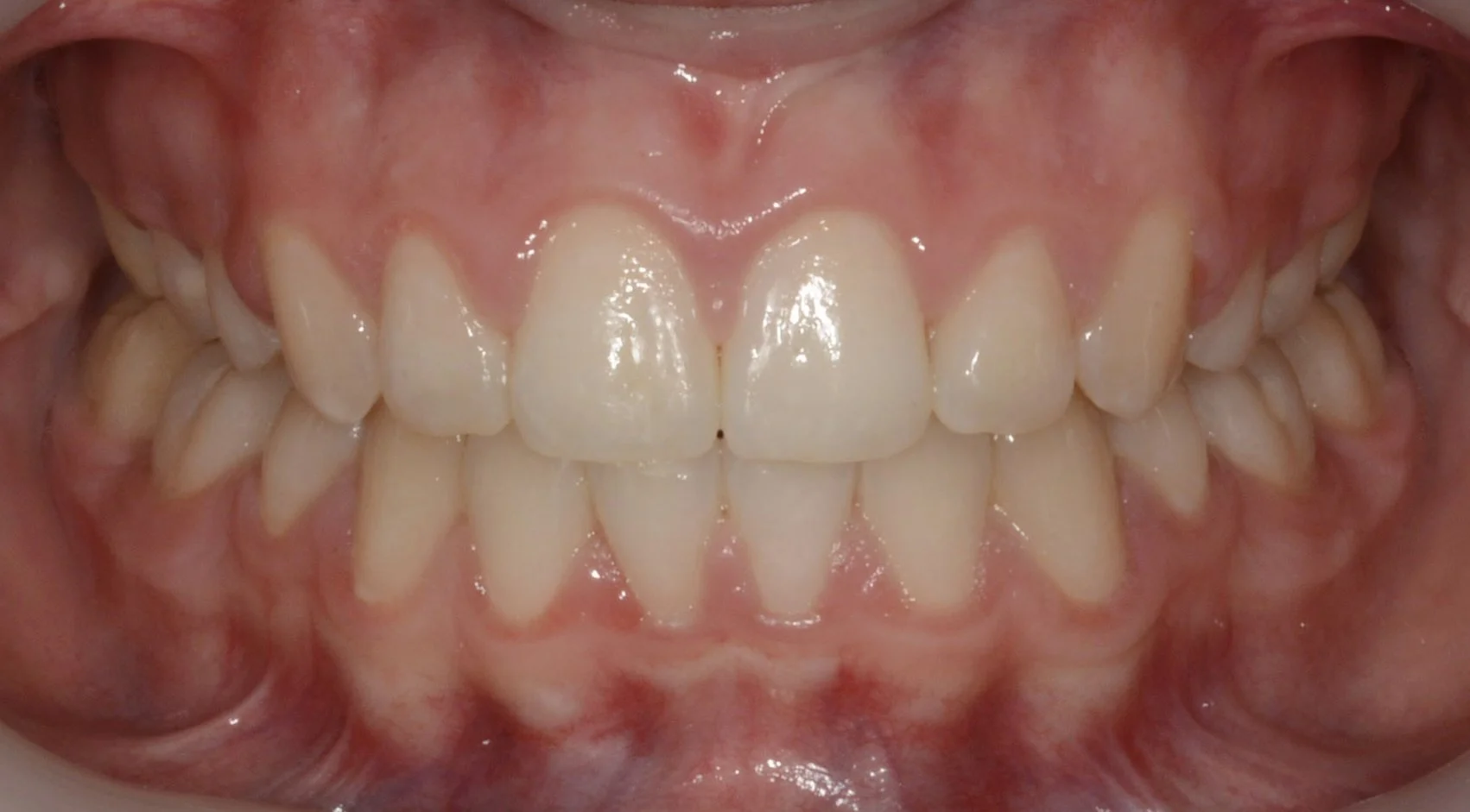 Close-up of a person's open mouth showing upper and lower teeth with some slight crowding and gum redness.